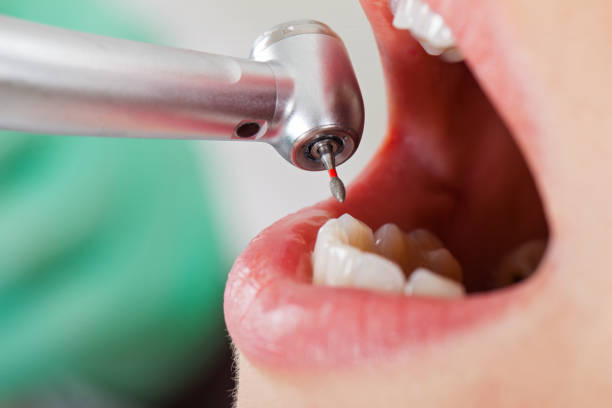 Best Emergency Wisdom Tooth Extraction in Occoquan, VA